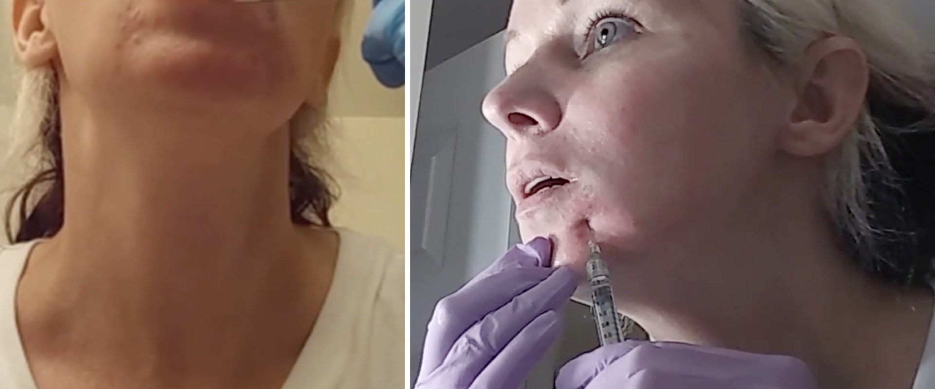 The Dangers of SelfInjecting Dermal Fillers